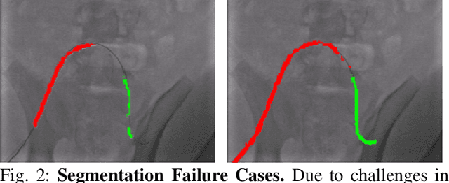 Figure 2 for SplineFormer: An Explainable Transformer-Based Approach for Autonomous Endovascular Navigation