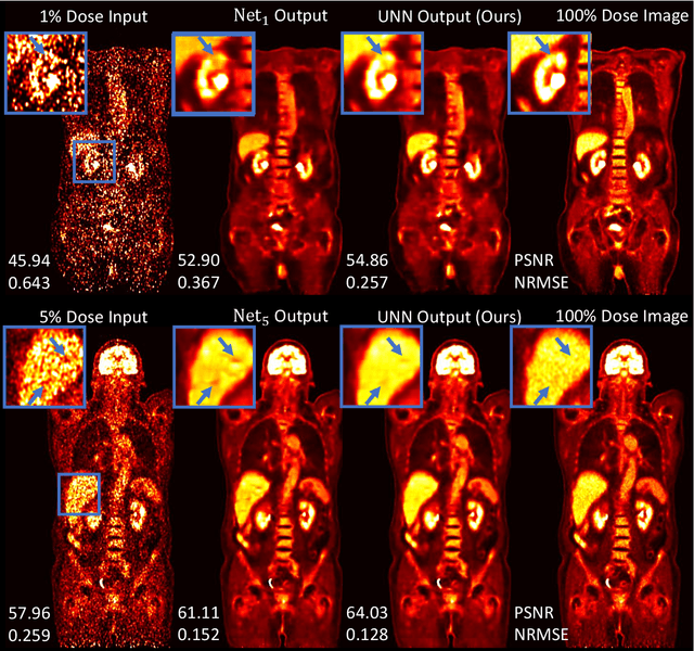 Figure 3 for Unified Noise-aware Network for Low-count PET Denoising