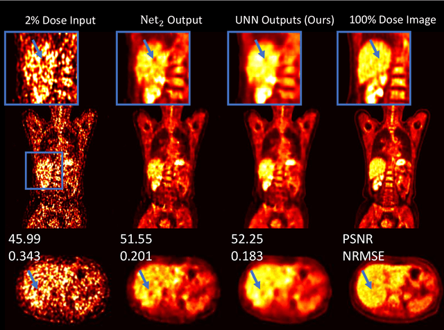 Figure 4 for Unified Noise-aware Network for Low-count PET Denoising