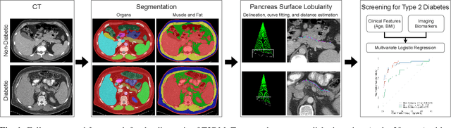 Figure 1 for Utility of Pancreas Surface Lobularity as a CT Biomarker for Opportunistic Screening of Type 2 Diabetes