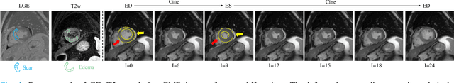 Figure 1 for CineMyoPS: Segmenting Myocardial Pathologies from Cine Cardiac MR