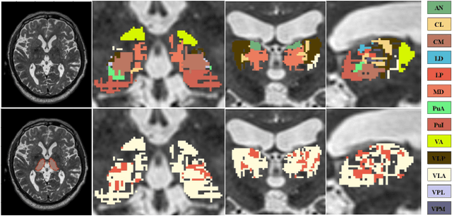 Figure 1 for Label Propagation via Random Walk for Training Robust Thalamus Nuclei Parcellation Model from Noisy Annotations