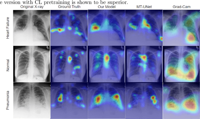 Figure 3 for Joint chest X-ray diagnosis and clinical visual attention prediction with multi-stage cooperative learning: enhancing interpretability