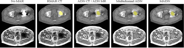 Figure 3 for Combining multimodal information for Metal Artefact Reduction: An unsupervised deep learning framework