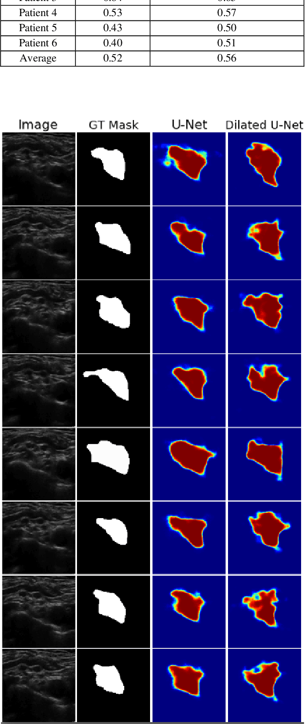 Figure 4 for Automatic Ultrasound Image Segmentation of Supraclavicular Nerve Using Dilated U-Net Deep Learning Architecture