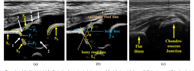 Figure 1 for Joint Landmark and Structure Learning for Automatic Evaluation of Developmental Dysplasia of the Hip