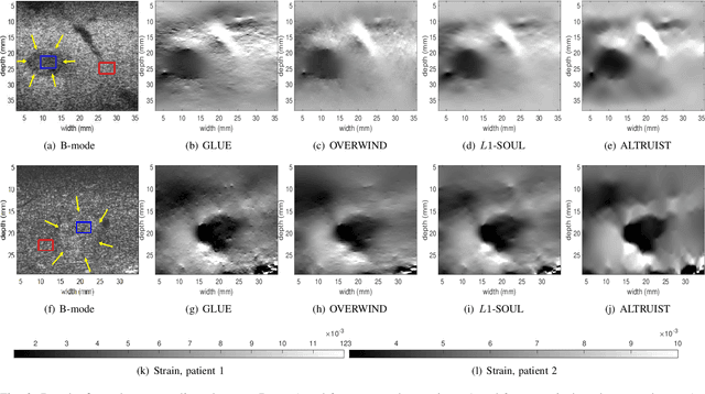 Figure 4 for ALTRUIST: Alternating Direction Method of Multipliers for Total Variation Regularization in Ultrasound Strain Imaging