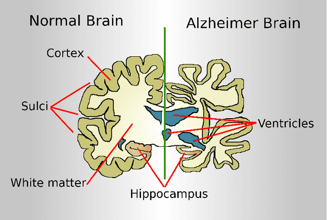Figure 3 for A Survey on Automated Diagnosis of Alzheimer's Disease Using Optical Coherence Tomography and Angiography