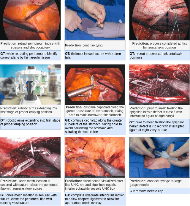 Figure 2 for Surgical Instruction Generation with Transformers