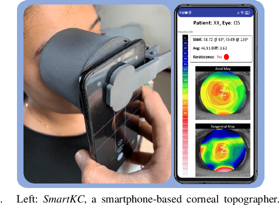 Figure 1 for Keratoconus Classifier for Smartphone-based Corneal Topographer