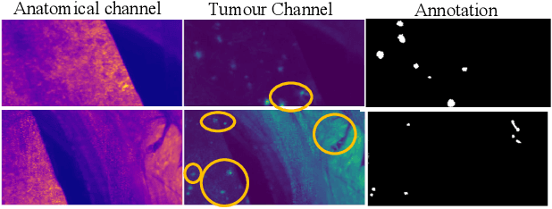 Figure 1 for METGAN: Generative Tumour Inpainting and Modality Synthesis in Light Sheet Microscopy