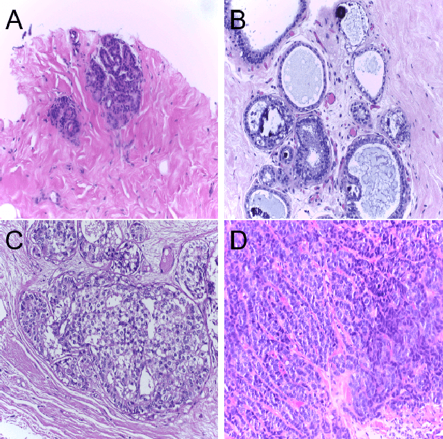 Figure 1 for Classification of Breast Cancer Histology using Deep Learning
