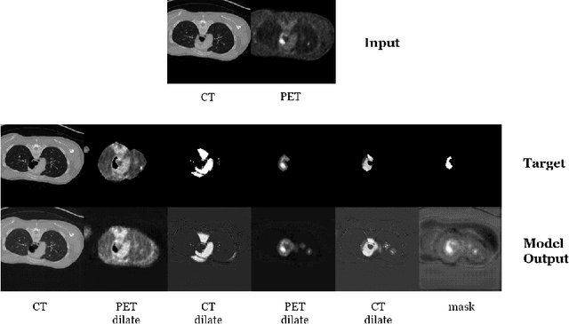 Figure 1 for AutoPET Challenge 2022: Step-by-Step Lesion Segmentation in Whole-body FDG-PET/CT