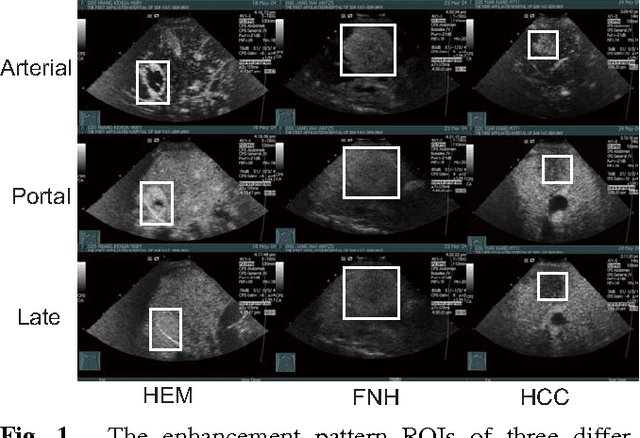 Figure 1 for Recognizing Focal Liver Lesions in Contrast-Enhanced Ultrasound with Discriminatively Trained Spatio-Temporal Model