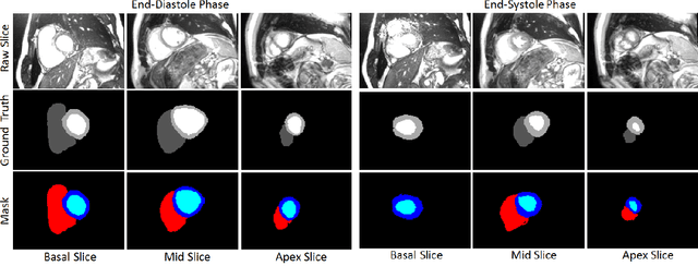 Figure 3 for CondenseUNet: A Memory-Efficient Condensely-Connected Architecture for Bi-ventricular Blood Pool and Myocardium Segmentation