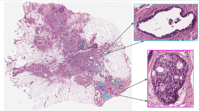 Figure 1 for BRACS: A Dataset for BReAst Carcinoma Subtyping in H&E Histology Images