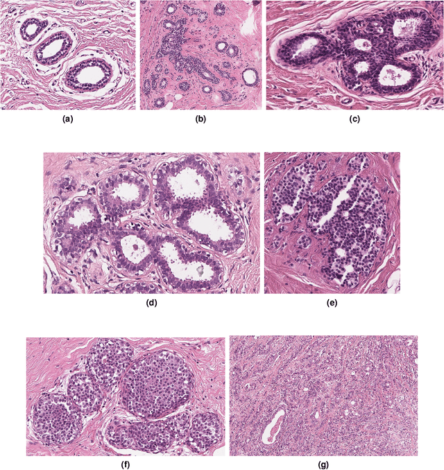 Figure 3 for BRACS: A Dataset for BReAst Carcinoma Subtyping in H&E Histology Images