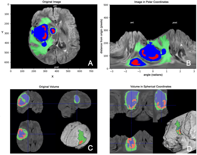 Figure 1 for Spherical coordinates transformation pre-processing in Deep Convolution Neural Networks for brain tumor segmentation in MRI