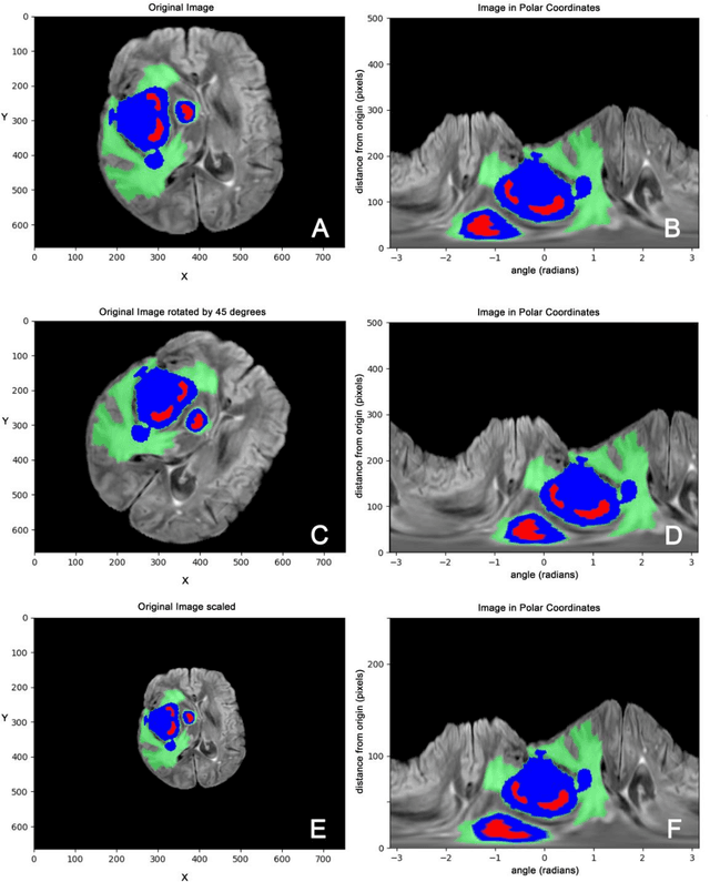 Figure 3 for Spherical coordinates transformation pre-processing in Deep Convolution Neural Networks for brain tumor segmentation in MRI