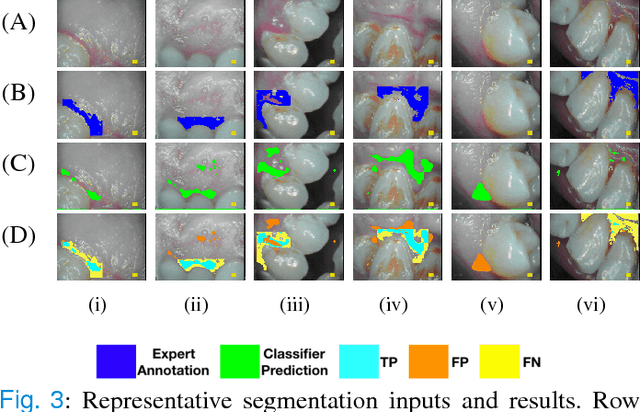 Figure 4 for Automated Process Incorporating Machine Learning Segmentation and Correlation of Oral Diseases with Systemic Health