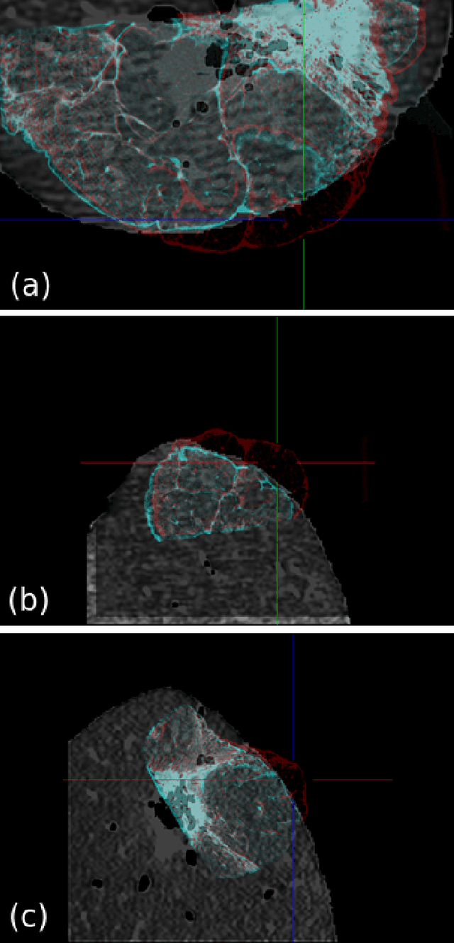 Figure 2 for Multi-scale Image Fusion Between Pre-operative Clinical CT and X-ray Microtomography of Lung Pathology