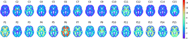 Figure 3 for Patch vs. Global Image-Based Unsupervised Anomaly Detection in MR Brain Scans of Early Parkinsonian Patients