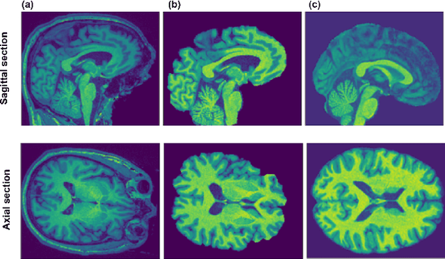 Figure 1 for 3D Deformable Convolutions for MRI classification