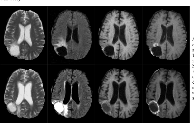 Figure 1 for Comparison of different automatic solutions for resection cavity segmentation in postoperative MRI volumes including longitudinal acquisitions