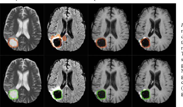 Figure 3 for Comparison of different automatic solutions for resection cavity segmentation in postoperative MRI volumes including longitudinal acquisitions