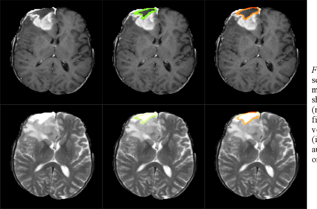Figure 4 for Comparison of different automatic solutions for resection cavity segmentation in postoperative MRI volumes including longitudinal acquisitions