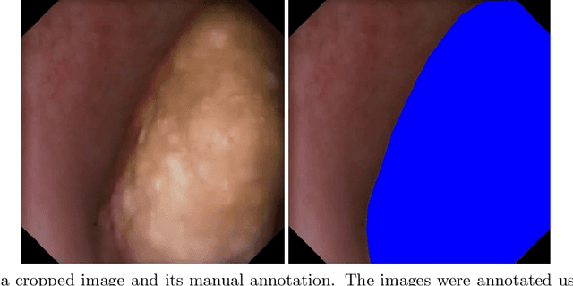 Figure 1 for Segmentation of kidney stones in endoscopic video feeds