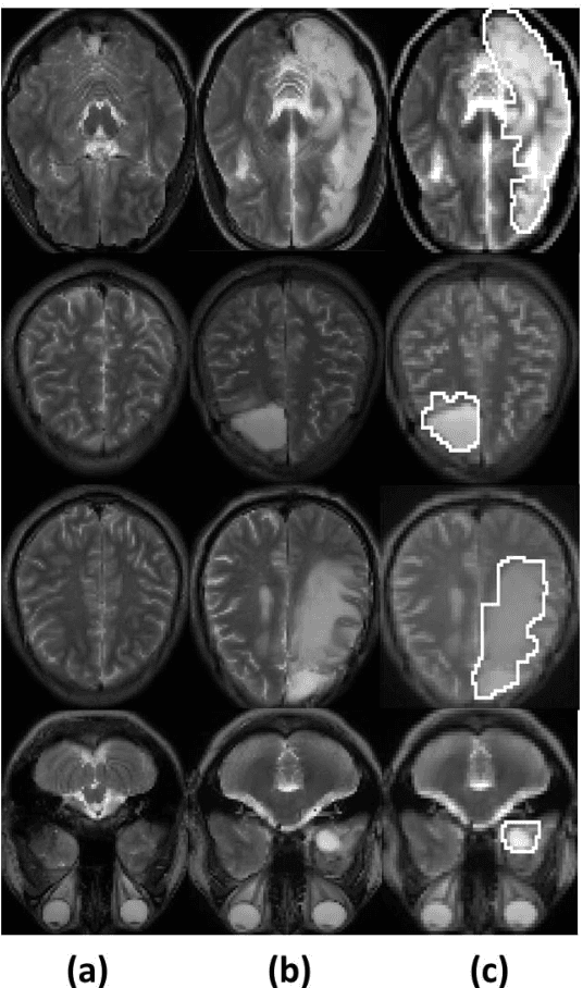 Figure 3 for Tumor Classification and Segmentation of MR Brain Images