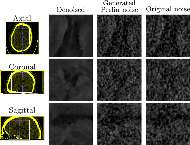 Figure 4 for Synthetic vascular structure generation for unsupervised pre-training in CTA segmentation tasks