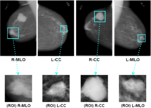Figure 3 for Breast Cancer Classification using Deep Learned Features Boosted with Handcrafted Features