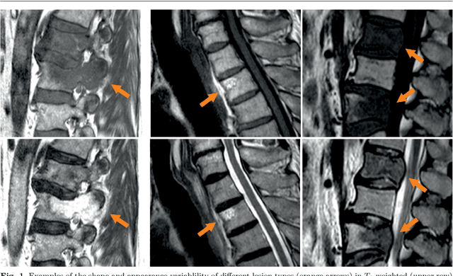 Figure 1 for Spinal Metastases Segmentation in MR Imaging using Deep Convolutional Neural Networks