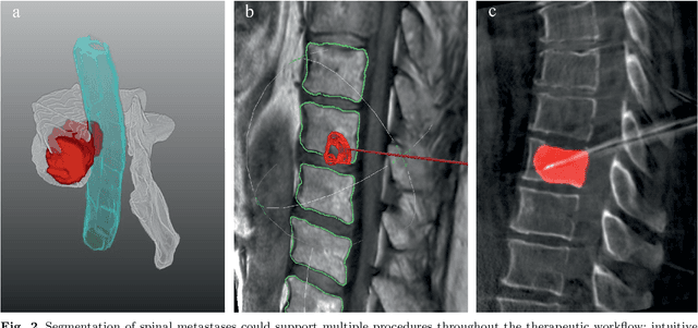 Figure 2 for Spinal Metastases Segmentation in MR Imaging using Deep Convolutional Neural Networks