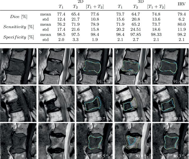Figure 4 for Spinal Metastases Segmentation in MR Imaging using Deep Convolutional Neural Networks