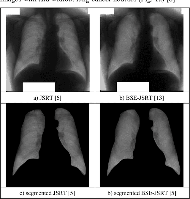 Figure 1 for Dimensionality Reduction in Deep Learning for Chest X-Ray Analysis of Lung Cancer