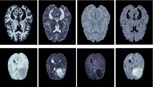 Figure 3 for Medical Image Segmentation on MRI Images with Missing Modalities: A Review