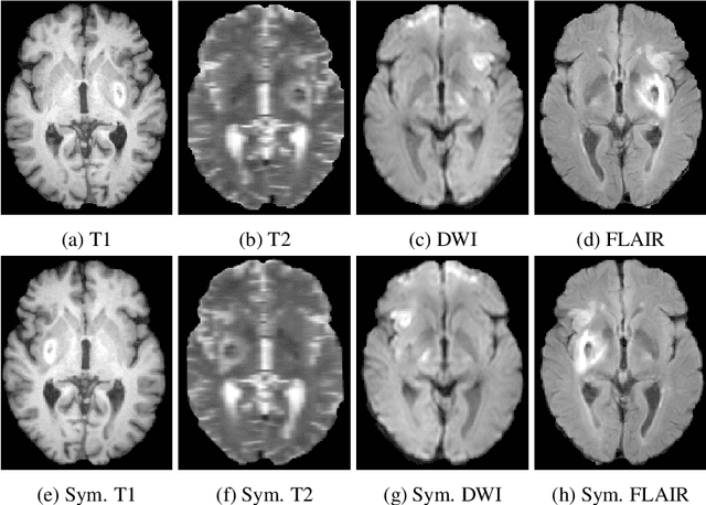 Figure 1 for SUNet: a deep learning architecture for acute stroke lesion segmentation and outcome prediction in multimodal MRI