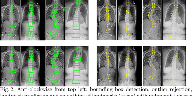 Figure 3 for Automatic Cobb Angle Detection using Vertebra Detector and Vertebra Corners Regression