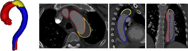 Figure 1 for ImageTBAD: A 3D Computed Tomography Angiography Image Dataset for Automatic Segmentation of Type-B Aortic Dissection