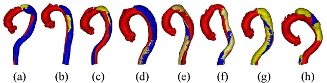 Figure 3 for ImageTBAD: A 3D Computed Tomography Angiography Image Dataset for Automatic Segmentation of Type-B Aortic Dissection