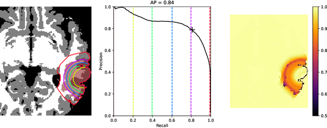 Figure 1 for Evaluating glioma growth predictions as a forward ranking problem
