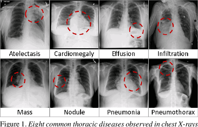 Figure 1 for ChestX-ray8: Hospital-scale Chest X-ray Database and Benchmarks on Weakly-Supervised Classification and Localization of Common Thorax Diseases
