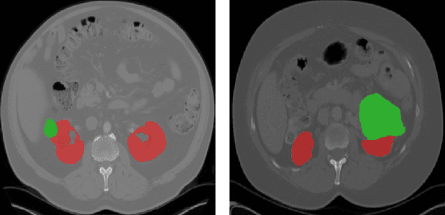 Figure 1 for 3D Kidneys and Kidney Tumor Semantic Segmentation using Boundary-Aware Networks