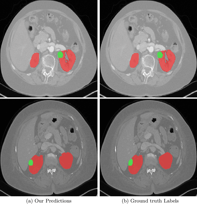 Figure 4 for 3D Kidneys and Kidney Tumor Semantic Segmentation using Boundary-Aware Networks