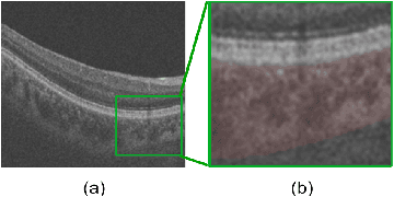 Figure 1 for BioNet: Infusing Biomarker Prior into Global-to-Local Network for Choroid Segmentation in Optical Coherence Tomography Images