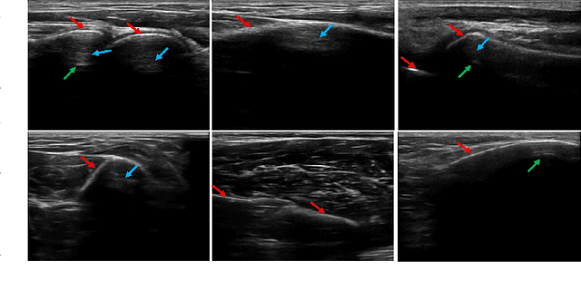 Figure 2 for Delineating Bone Surfaces in B-Mode Images Constrained by Physics of Ultrasound Propagation
