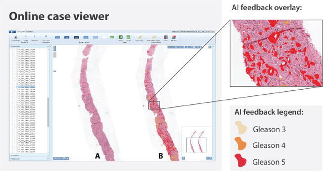 Figure 1 for Artificial Intelligence Assistance Significantly Improves Gleason Grading of Prostate Biopsies by Pathologists